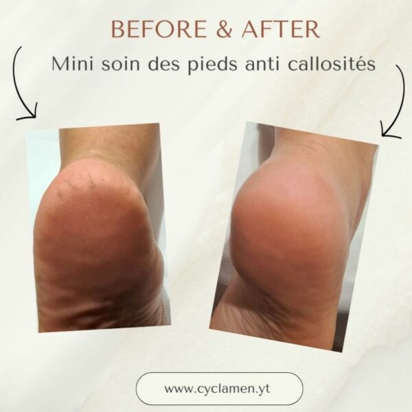 Mini soin des pieds - Anti Callosites